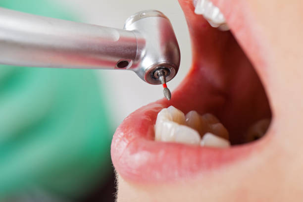 Best Emergency Root Canal Treatment in Kdeer, IL